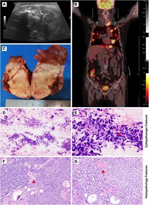 KMT2C mutation is a diagnostic molecular marker for primary thyroid osteosarcoma: A case report and literature review